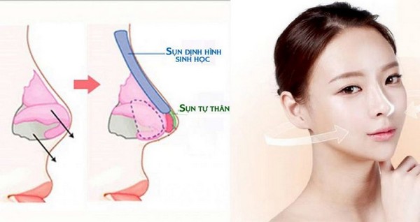 Phương pháp nâng mũi phù hợp nhất với da mũi mỏng