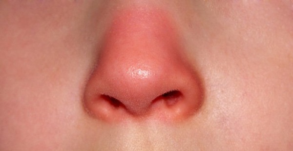 Nguyên nhân mũi bị đỏ sau nâng