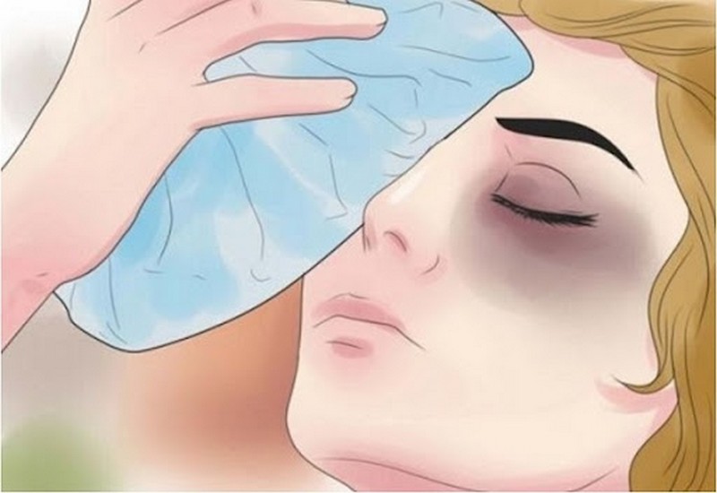 cách làm tan máu bầm sau nâng mũi 