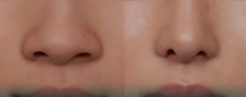 Tìm hiểu về cuộn cánh mũi và cách phân biệt với cắt cánh mũi