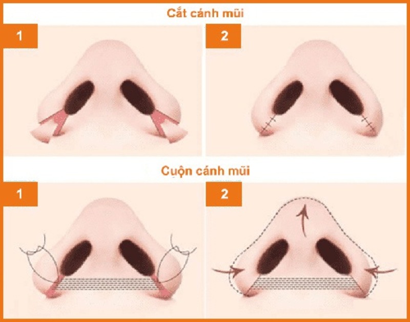 Tìm hiểu về cuộn cánh mũi và cách phân biệt với cắt cánh mũi