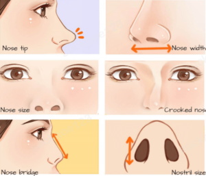 Tác hại của nâng mũi bằng sụn